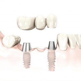 3_unit_implant_bridge_ti_abutments_1l_red